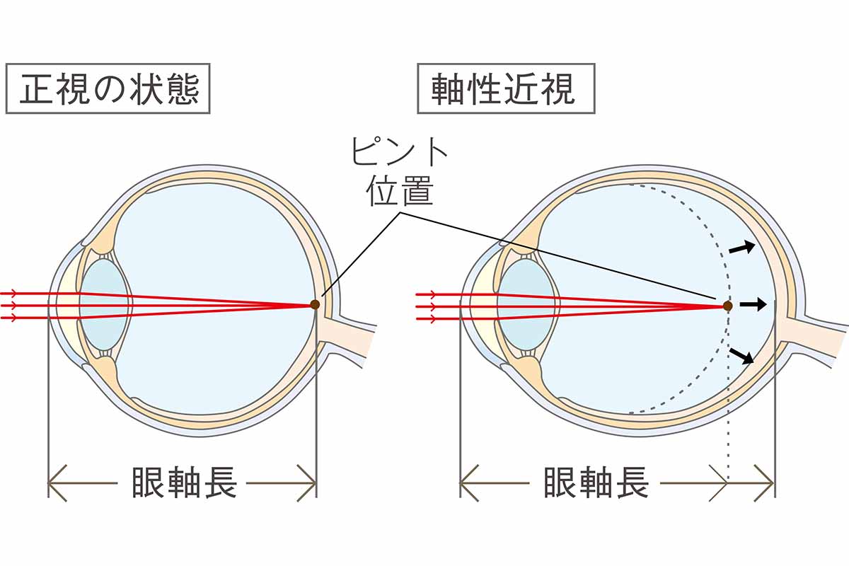 近視の進行を抑制することが大切な理由