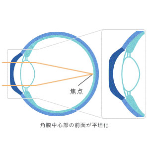 装用後（裸眼時）